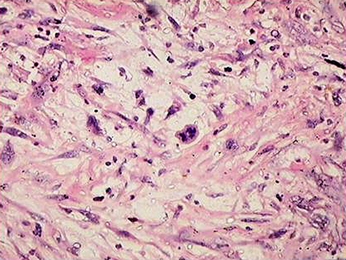 Figure 2: Photomicrograph showing fascicles of brightly eosinophilic spindle cells with ovoid to cigar shaped nuclei intersecting each other at wide angles