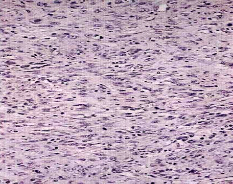 Figure 3: Immunohistochemistry revealed intense cytoplasmic positivity for Desmin in all the cells