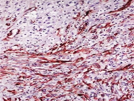 Figure 4: Immunohistochemistry revealed intense cytoplasmic positivity for smooth muscle actin in all the cells