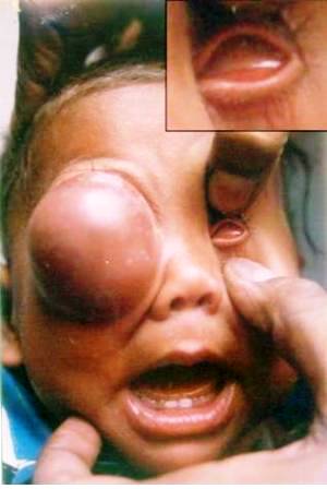 Figure 1: large cystic mass in the right orbit with anophthalmos left side (Inset: left eye showing absence of eyeball.