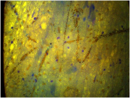 Figure 1: Histological section of the brain shows malaria pigments in cerebral blood vessels. X400 May-Grunwld Giemsa stains.