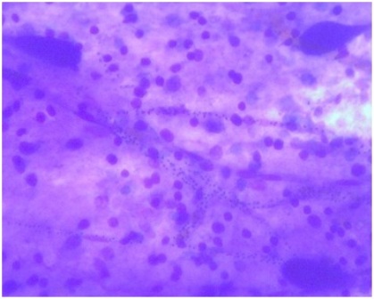 Figure 2: May-Grunwld Giemsa stain showing malaria pigments within cerebral blood vessels Mag x400.