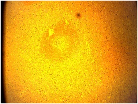 Figure 3: H&E Stain: Section of the brain showing ring hemorrhage, Mag x4.