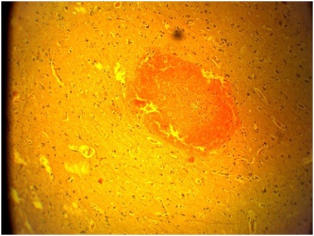 Figure 4: H&E Stain: Section of the brain showing ring haemorrhage within the cortex, Mag x4.