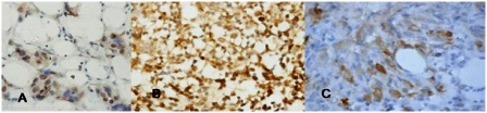 Figure 2: Immunohistochemistry for survivin in breast cancer. a) Nuclear stain positivity; b) Nuclear and cytoplasmic; c) Cytoplasmic stain positivity