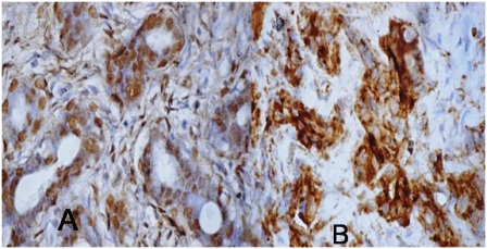 Figure 3: survivin immunohistochemistry in fibroadenoma: A) Ductal cells have intense positivity(Nuclear 3+), B) Cytoplasmic (3+) positivity