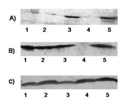 Figure 4: Expression of Survivin protein analyzed using western blotting: A) Fibroadenoma and B) Breast cancer C) beta Actin as control