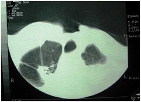 Figure 1: Computerized tomography of the chest showing pulmonary tuberculosis
