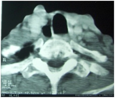 Figure 2: CT scan of the neck showing metastasis to the cervical vertebra