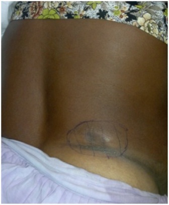 Figure 1-Soft tissue metastasis from breast cancer