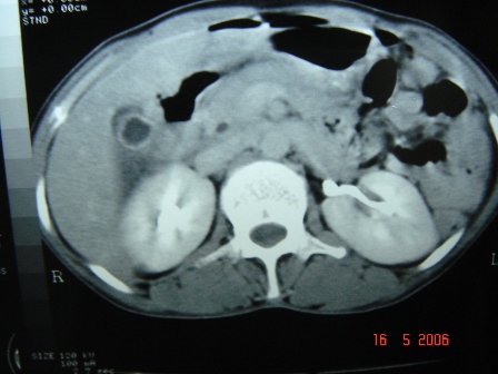 Figure 1.CT scan of abdomen showing gas in gallbladder lumen, wall and pericholecystic region.