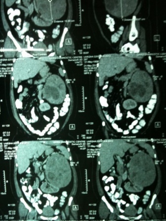 Figure 1: contrast enhanced CT scan of abdomen showing left adrenal mass.