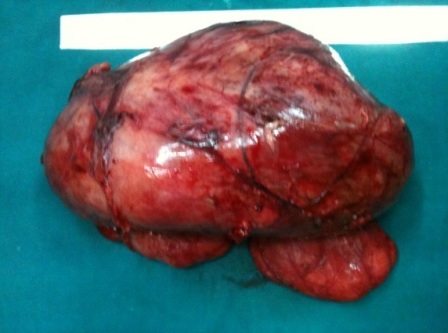 Figure 2: Resected specimen of Left adrenal mass.