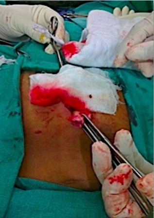 Figure 1: Sinus track is dissected off from skin