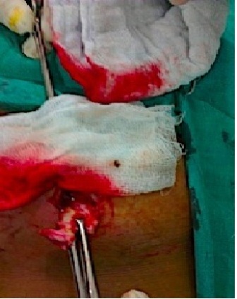 Figure 2: Sinus track is completely dissected towards intact peritoneum