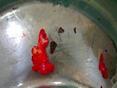 Figure 3: Specimen of sinus track along with three gall stones