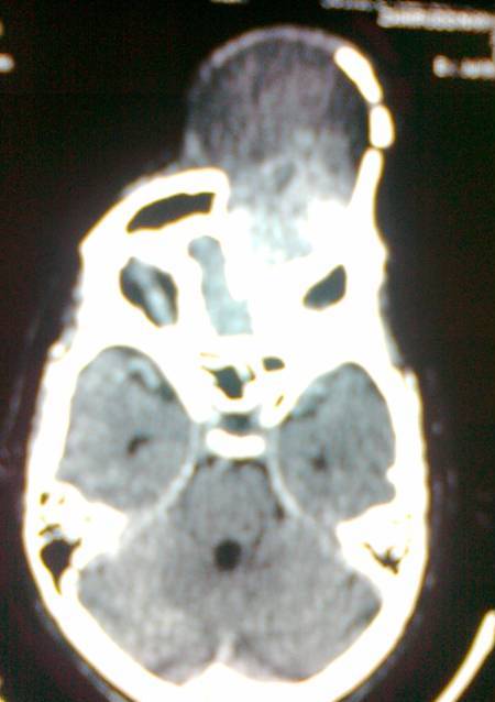 Fig.3: CT scan axial sectionof giant left frontal mucocele 