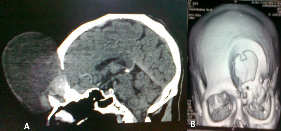 Fig.4: CT scan (a) sagittal section and (b) 3 D view renstruction showing bony defect of giant left frontal mucocele