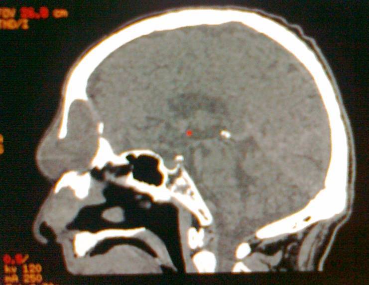 Fig.5.sagittal section of frontal mucocele