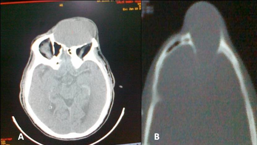 Fig 6. CT scan (a) axial cut brain and (b) bone window: a giant right frontal mucocele