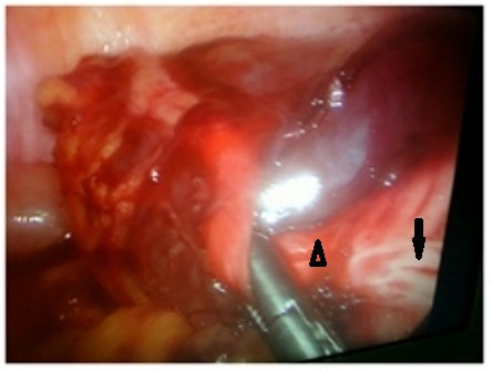 Figure 2: Showing appendicular dissection starting at base (triangle) and the tenia coli (arrow)