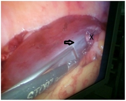 Figure 3: Show suction cannula inside the cyst (arrow) and the base of appendix (X).