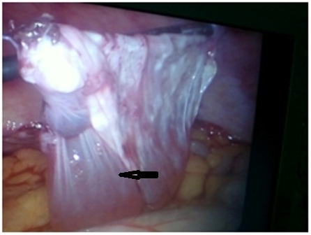 Figure 4: showing some residual fluid inside the cyst