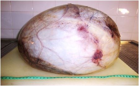 Figure 2: Gross picture showing prominent vascular channels and areas of hemorrhage.