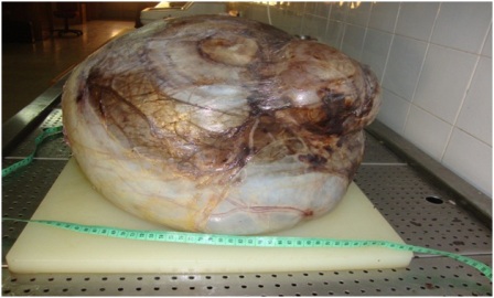 Figure 3: Gross picture showing prominent vascular channels and brownish-black areas reminiscent of old hemorrhage. There is a solid part on the upper right quadrant of the cystic mass. This is the remaining part of the kidney.