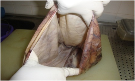 Figure 4: The cystic mass has been opened showing the inner shiny surface. 