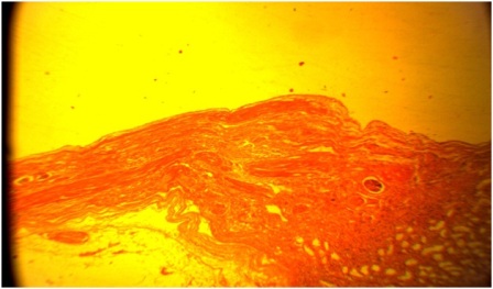 Figure 5: Histological section showing the wall of the cyst lined by flattened epithelium and the wall exhibiting renal glomerulus and tubules. X 40.