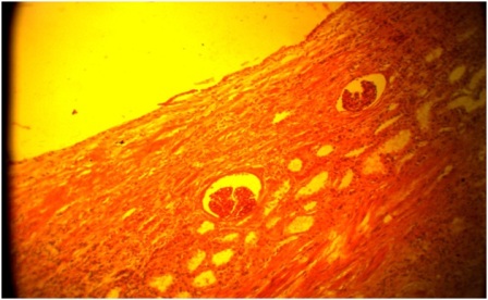 Figure 6: Histological section showing the wall of the cyst lined by flattened to cuboidal epithelium and the wall exhibiting renal glomeruli and tubules with lymphocytic infilterates. X 100. 