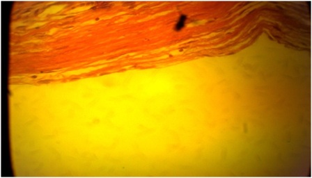 Figure 7: Section of the cyst wall showing the flattened epithelium at higher magnification. X 400.