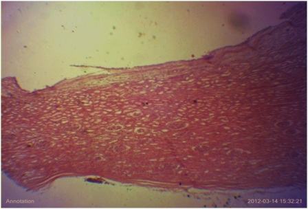 Figure 8: Histological section showing the wall of the cyst lined by flattened epithelium and the wall exhibiting renal glomerulus and tubules. X 40.