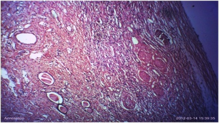 Figure 9: Histological section showing thyroidization of some tubules and lymphocytic infiltrates within the interstitium. This is compatible with chronic pyelonephritis  X 100 .