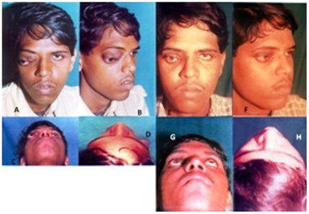 Figure 1: Clinical photograph (a-d) Preoperative photograph showing proptosis with downward and outward displacement of globe. (e-h) Postoperative photograph with absence of proptosis 