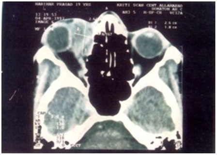 Figure 2 Preoperative orbital computed tomography (CT) scan showing right eye ball compressed and displaced downward and outward due to oval shaped mass (2.6 x 1.8 cm) supero-medially
