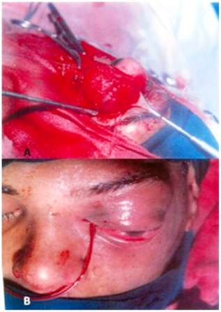 Figure 3: (A) Peroperative photograph showing trans-conjuctival orbitotomy; (B) Immediate postoperative photograph