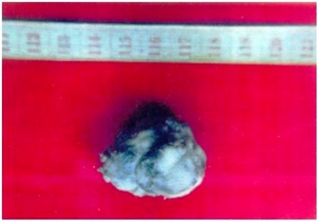 Figure 4: Gross appearance of the excised mass.