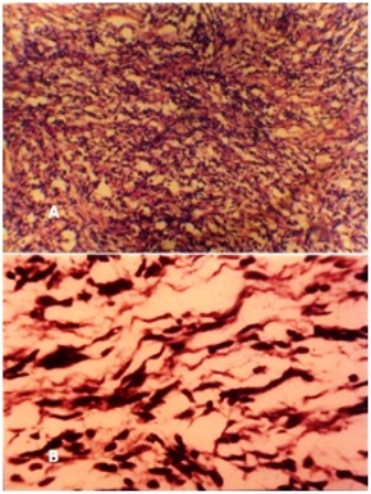 Figure 5: Photomicrograph (A: H and E 40 x) and (B: H and E 100 x) showing neural cells having wavy nuclei in loose fibrillar background