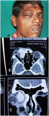 Figure 6: Clinical photograph and CT scan showing late recurrence.