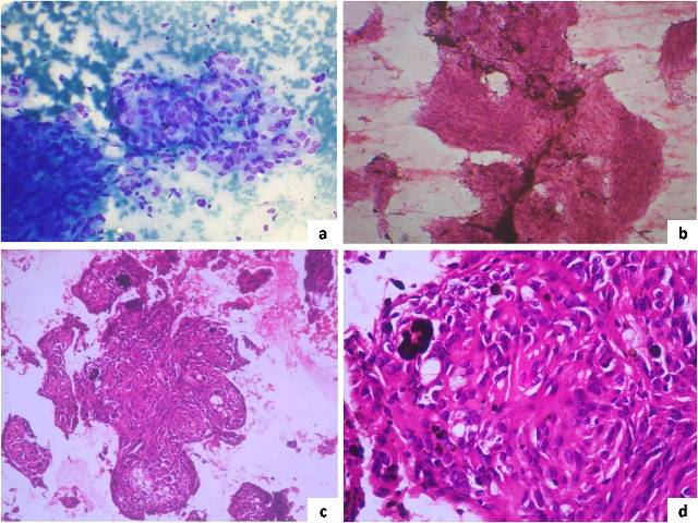 Figure 2- Panel showing a case of meningeal melanocytoma; 2a- Syncytial clusters of oval shaped tumor cells forming whorls (MGGx40X); 2b- Highly cellular tumor with tumor cells showing abundant melanin pigment (H&E x20X); 2c- Cell block showing whorled appearance of tumor cells (H&E x20X); 2d- Cell block showing syncytial tumor clusters with cells containing abundant black pigment (H&E x40X).