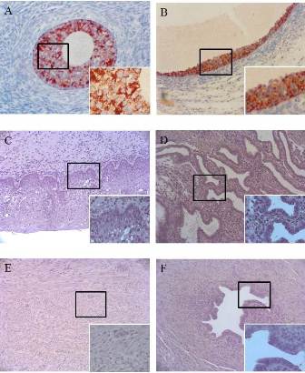 Fig. 1(A): In human ovary specimen, small antral follicle state, strongly express MIS in the granulose cell membrane. Right lower figure is higher magnification of the boxed area (400 X). Chromogen: AEC. Magnification, 200 X. (B) in human ovary specimen, antral follicle state, strongly express MIS in the granulose cell membrane. Right lower figure is higher magnification of the boxed area (400 X). Chromogen: AEC. Magnification, 200 X.(C) In human uterine cervix specimen, no reactivity for MIS Immunohistochemistry. Right lower figure is higher magnification of the boxed area (400 X). Chromogen: AEC. Magnification, 200 X. (D) In human uterine endometrium specimen, no reactivity for MIS Immunohistochemistry. Right lower figure is higher magnification of the boxed area (400 X). Chromogen: AEC. Magnification, 200 X. (E) In human uterine myometrium specimen, no reactivity for MIS Immunohistochemistry. Right lower figure is higher magnification of the boxed area (400 X). Chromogen: AEC. Magnification, 200 X. (F) In human uterine tube specimen, no reactivity for MIS Immunohistochemistry. Right lower figure is higher magnification of the boxed area (400 X). Chromogen: AEC. Magnification, 200 X.