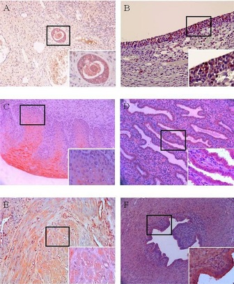 Figure 2(A): In human ovary specimen, small antral follicle state, strongly express MISRII in the cell membrane. Right lower figure is higher magnification of the boxed area (400 X). Chromogen: AEC. Magnification, 200 X. (B) In human ovary specimen, antral follicle state, strongly express MISRII in the cell membrane. Right lower figure is higher magnification of the boxed area (400 X). Chromogen: AEC. Magnification, 200 X.(C) In human uterine cervix specimen, strongly express MISRII in the cell membrane. Right lower figure is higher magnification of the boxed area (400 X). Chromogen: AEC. Magnification, 200 X. (D) In human uterine endometrium specimen, strongly express MISRII in the cell membrane. Right lower figure is higher magnification of the boxed area (400 X). Chromogen: AEC. Magnification, 200 X. (E) In human uterine myometrium specimen, mildly express MISRII in the cell membrane. Right lower figure is higher magnification of the boxed area (400 X). Chromogen: AEC. Magnification, 200 X.(F) In human uterine tube specimen, strongly express MISRII in the cell membrane. Right lower figure is higher magnification of the boxed area (400 X). Chromogen: AEC. Magnification, 200 X. 