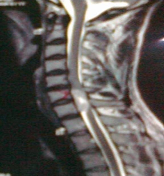Fig. 5: Intraspinal anterior cervical lesion in MRI