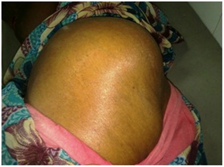 Figure 1- lesion in the left gluteal region