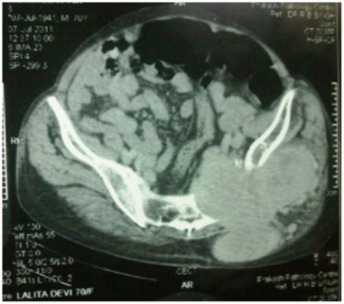 Figure 2- CT scan showing the lesion arising from left iliac bone