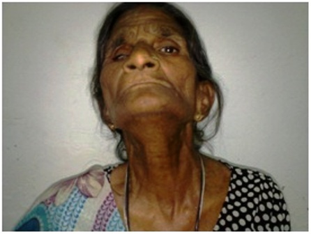 Figure 3- photograph of the patient showing absence of a goiter