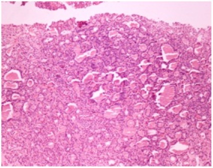 Figure 4- Histopathology of core needle biopsy showing follicular structures with eosinophilic colloid material resembling thyroid parenchyma