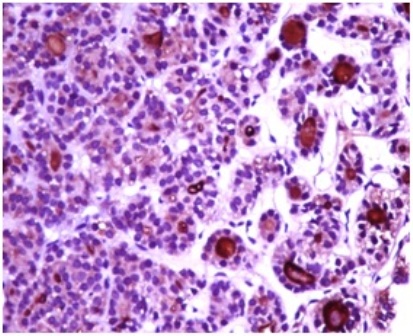 Figure – 5 photomicrograph showing strong Immunoreactivity for thyroglobulin